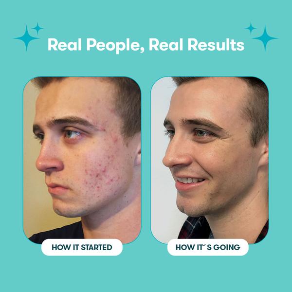 Proactiv Solution 60 Tage Routine 300 ml + 30 Zits Happen Patches