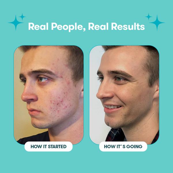 Proactiv Solution Hautpflege-Routine