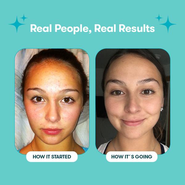 Proactiv Solution Hautpflege-Routine
